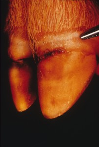 FMD coronry band lesion